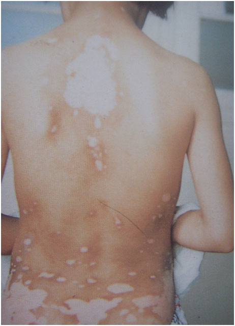 武汉背部患上白癜风该怎么办