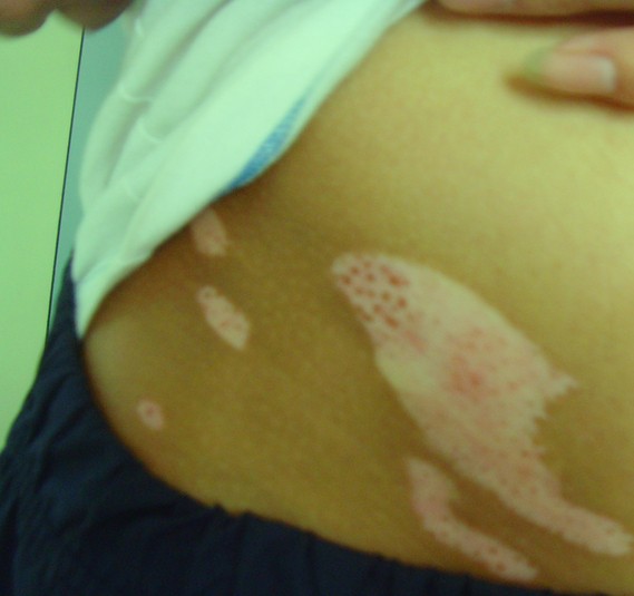 武汉想治好白癜风就要注意这些事