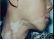 武汉应该如何治疗面部白癜风呢