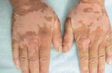 武汉如何治疗儿童白癜风