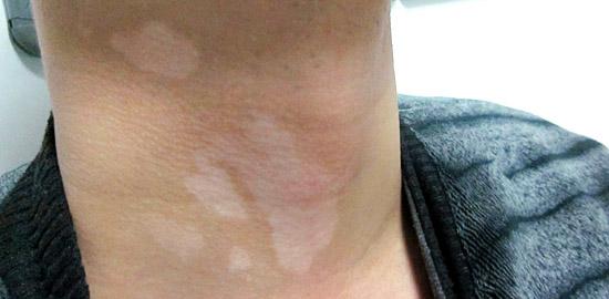 武汉有白癜风白斑怎么要去治疗