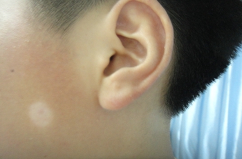 武汉白癜风现在能治愈吗