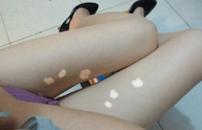 武汉治疗白癜风最有效的方法