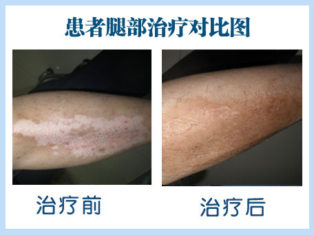 武汉白癜风如何治疗呢