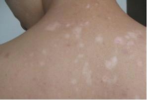 武汉白癜风早期治疗好吗