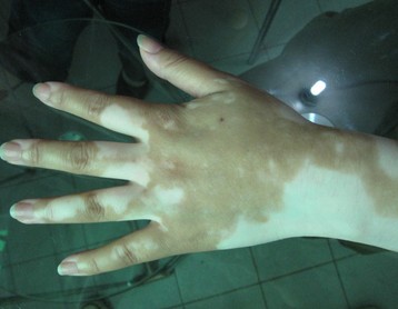 武汉治疗儿童白癜风注意事项