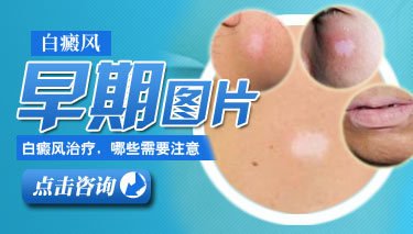 武汉白癜风初患该怎样治