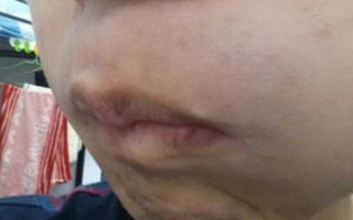 武汉白癜风好不好治疗