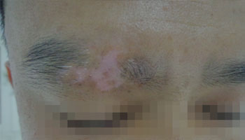 武汉关于白癜风到哪里治