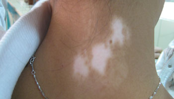 武汉白癜风比较好的治疗期