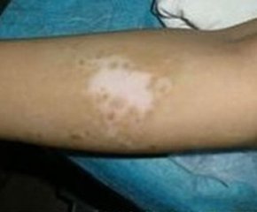 武汉白癜风可以医治吗