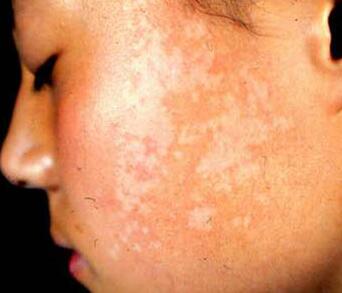 武汉白癜风治疗得看许多因素