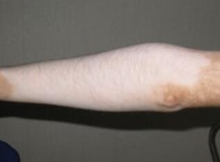 武汉治疗白癜风要使用哪些方法