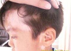 武汉白癜风初期治疗要注意些什么