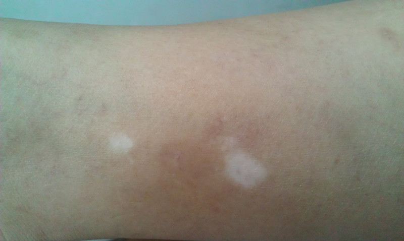 武汉怎么样治疗白癜风