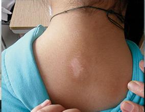 武汉治疗白癜风有哪些方法