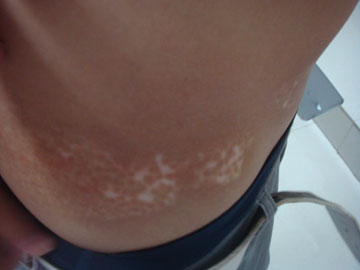 武汉详细介绍怎样治疗白癜风