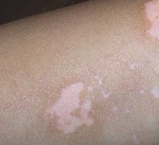 武汉白癜风发现的早怎么来治疗