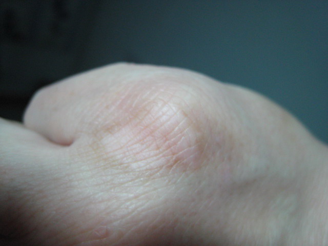 武汉大面积的白癜风怎么来治疗