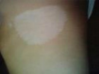 武汉白癜风治疗怎么来控制