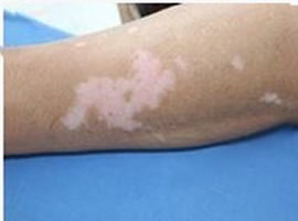 武汉治疗白癜风的方法有哪些呢