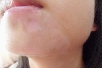 武汉白癜风初期如何治愈