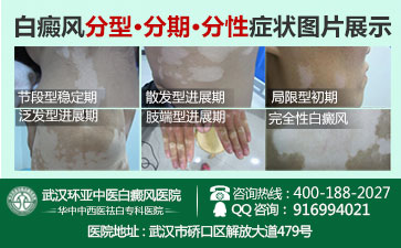 白癜风病是什么症状呢 白癜风病是什么症状呢