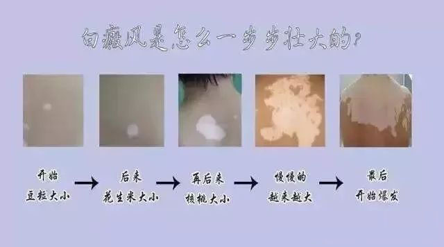 黄冈白癜风的发展期症状有什么