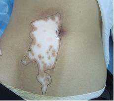 白癜风是怎么出现的?症状是什么样的?