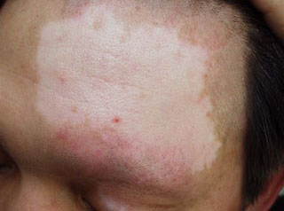 脸部长了几块白斑是什么