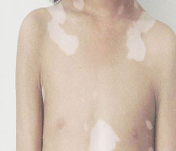 身上白斑是什么?是白癜风吗?