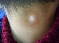 武汉白癜风症状有那些