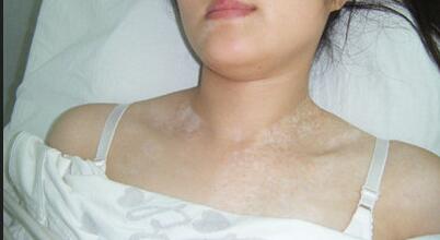 武汉脸部白癜风早期症状有哪些