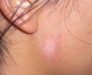 武汉白癜风最初症状是什么