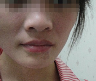 武汉哪些症状可以判定白斑就是白癜风