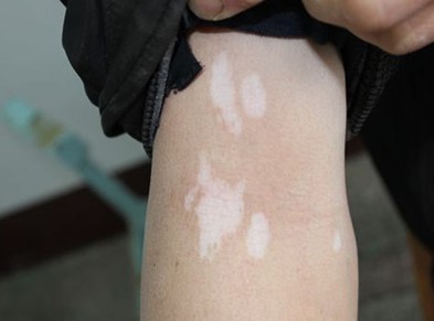 武汉孩子身上长白斑是白癜风的症状吗