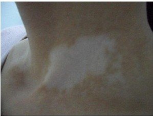 武汉夏天白癜风的症状有啥