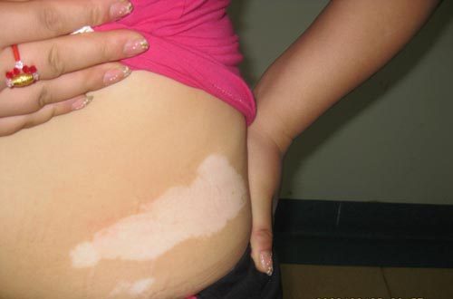 武汉白癜风初发时会出现哪些症状