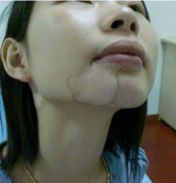 武汉白癜风病发的明显特征有哪些