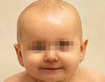 武汉儿童应该如何治疗白癜风