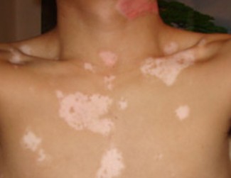 武汉儿童应该如何预防白癜风