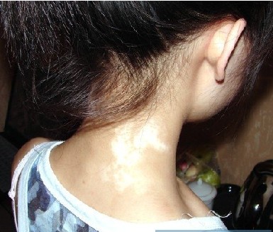 武汉儿童在治疗白癜风时需要注意什么