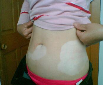 武汉小孩身上的白点是不是白癜风