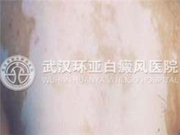 泛发型白癜风1.jpg