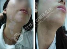 颈部白癜风治疗常识1.jpg