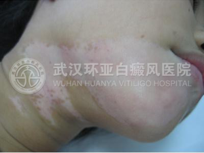节段型白癜风222.jpg