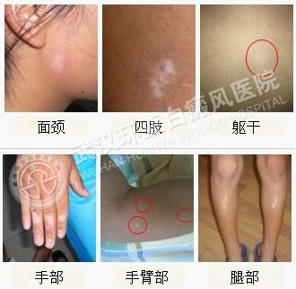 局限型白癜风的诱因是什么1.jpg