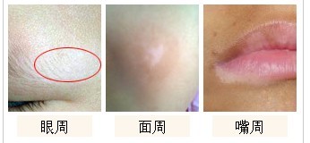 青少年脸部白癜风1.jpg