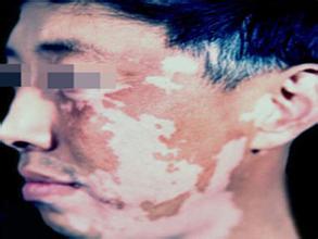 男性脸部白癜风的原因有哪些? 男性脸部白癜风的原因有哪些?