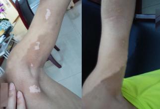 武汉武汉白癫特临环亚